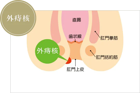 外痔核