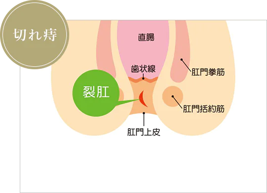 切れ痔